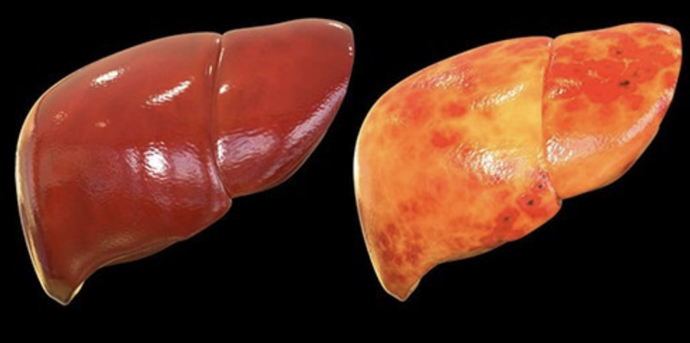 Khoảng 10–20% người gầy vẫn mắc gan nhiễm mỡ: Đừng để BMI “đánh lừa” sức khỏe gan